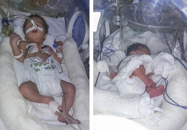 Gêmeos prematuros precisam de doações em Ituporanga