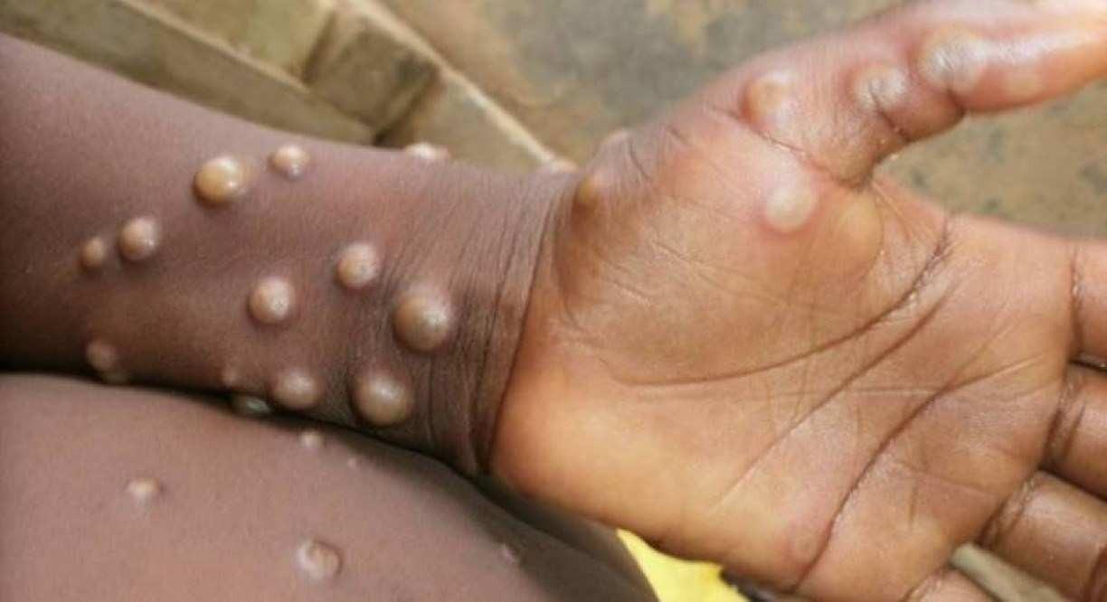 SC atinge 21 casos confirmados de varíola dos macacos