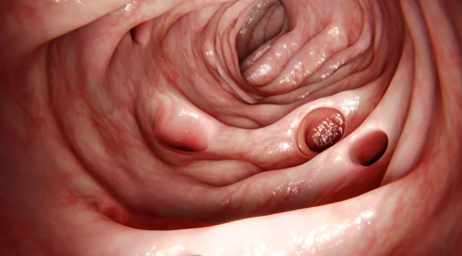 Dr. Clayton Guimarães: Doença diverticular do cólon - você sabe o que é?