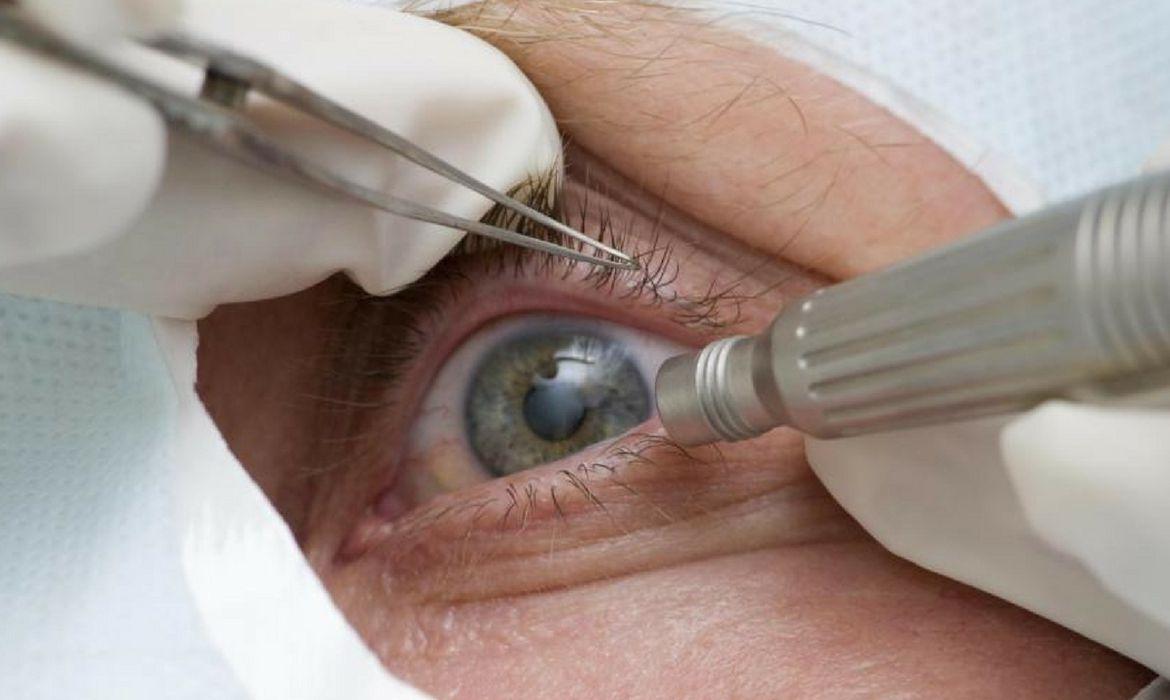 Hospital de Pouso Redondo fará novo mutirão de cirurgia de catarata