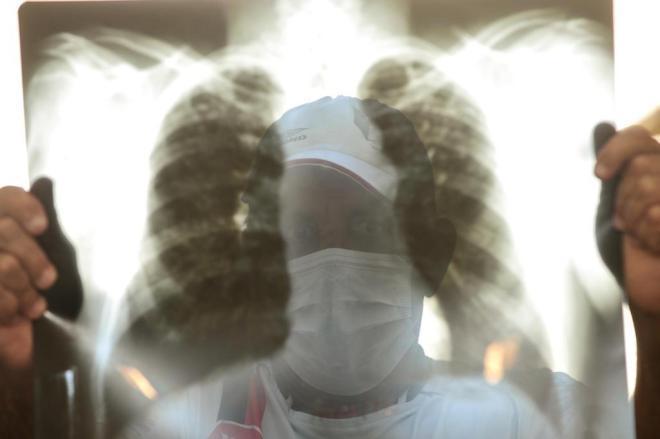 24 de Março: Hoje é o Dia Internacional da Tuberculose