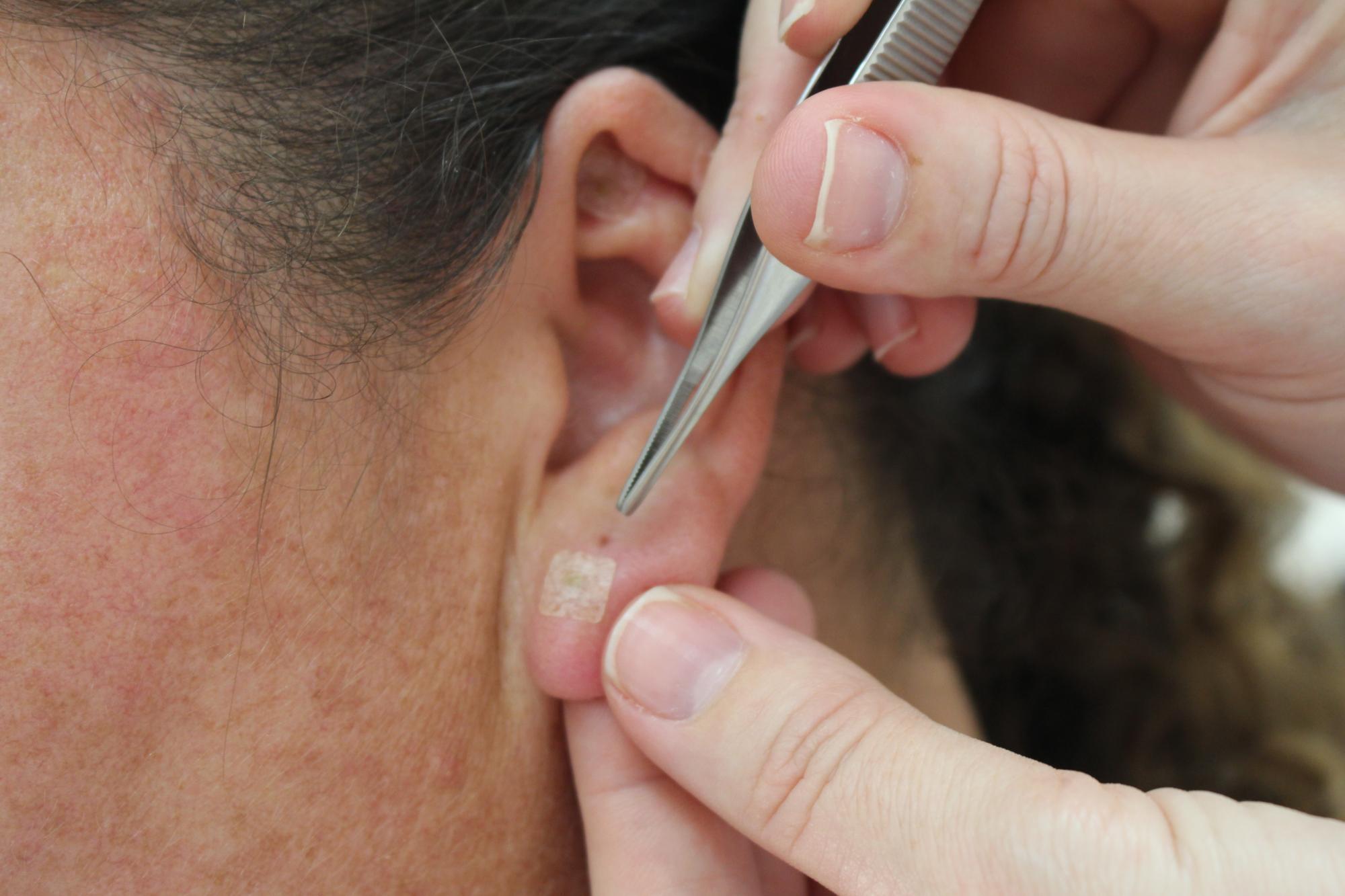 Acupuntura auricular é oferecida gratuitamente em Vidal Ramos