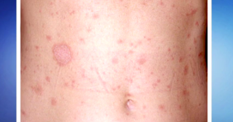 Pelo menos quatro casos de impetigo são registrados em Ituporanga