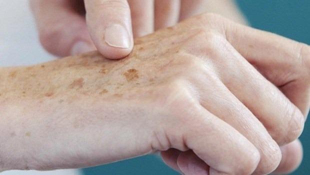 Protetor solar é principal aliado na prevenção ao câncer de pele