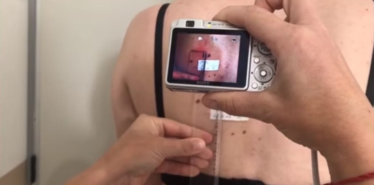 Telemedicina agiliza o diagnóstico de doenças da pele de pacientes em Imbuia
